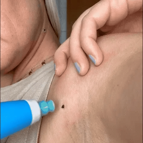 Papiloma Stop Комплект
